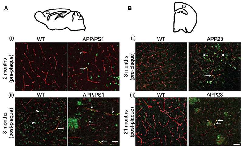 Blood vessel breakdown linked with Alzheimer's disease 