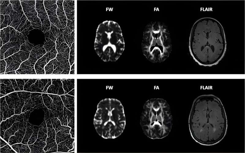 Study discovers possible tool to diagnose common contributor to vascular dementia 