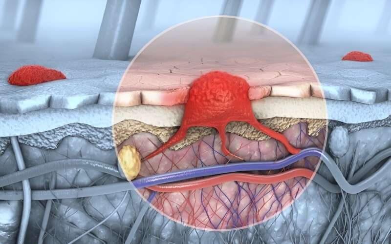 Smoking linked to melanoma-associated death in early-stage melanoma