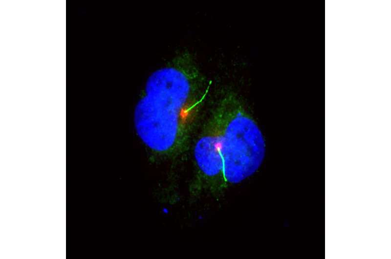 Loss of cilia leads to melanoma