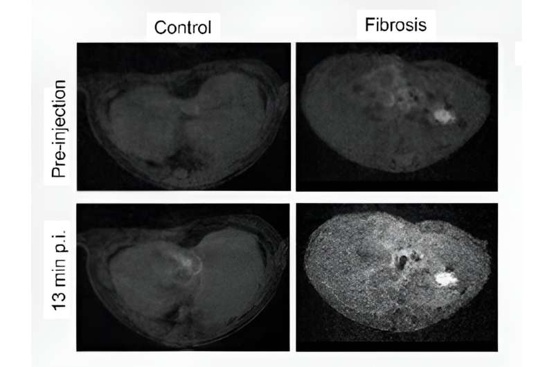 Targeted MRI detects chronic liver disease