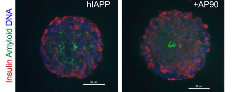 Q&A: How a potential treatment for Alzheimer's disease could also work for type 2 diabetes