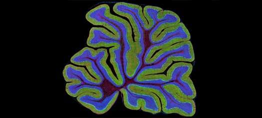 Atoh1, a potential Achilles' heel of Sonic Hedgehog medulloblastoma