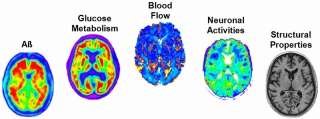 'Big Data' study discovers earliest sign of Alzheimer's development 