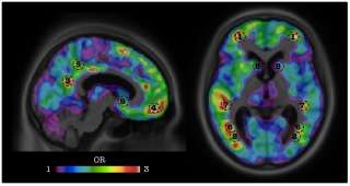 Artificial intelligence predicts dementia before onset of symptoms