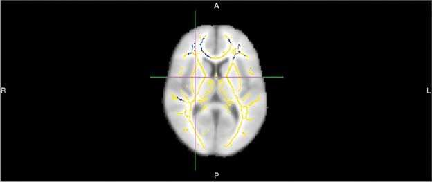 Researchers use MRI to predict Alzheimer's disease