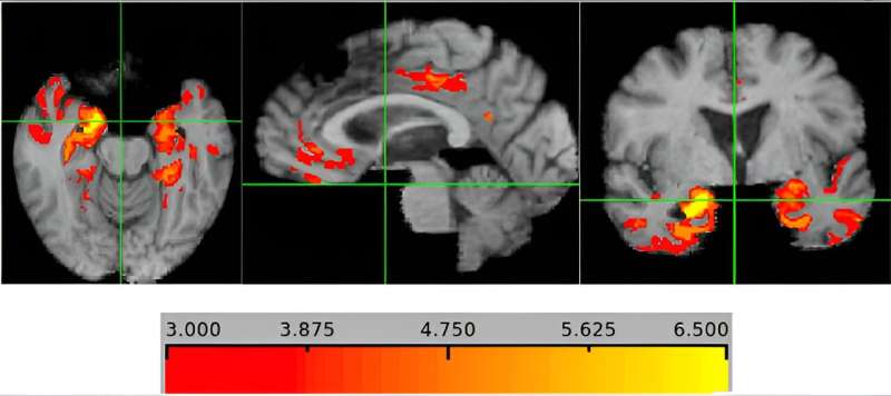 Thinning of brain region may signal dementia risk 5–10 years before symptoms