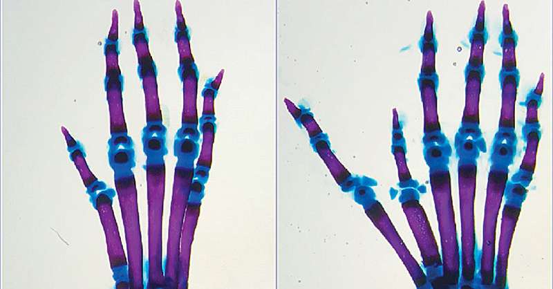 Extra fingers and hearts: Pinpointing changes to our genetic instructions that disrupt development