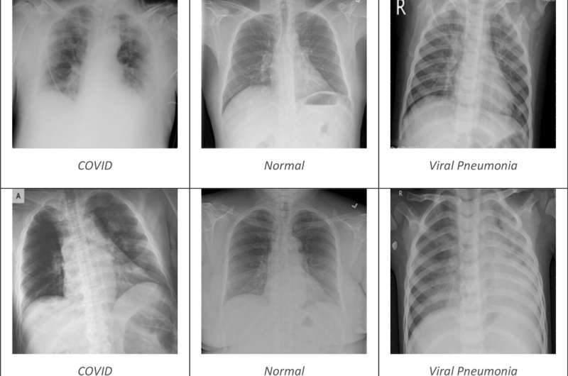 New AI tool accurately detects COVID-19 from chest X-rays