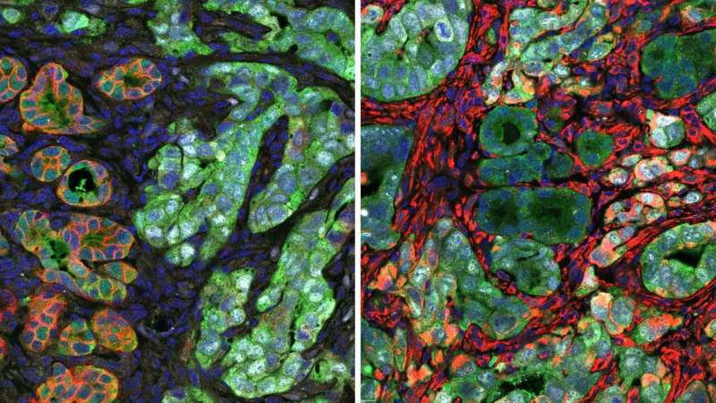 Mouse pancreatic tumors have extensive cell heterogeneity, as seen in these cross-sections. The early-stage pancreatic cancer cells (green and red) on the left have a more structured, organized shape. As they transform into a deadlier, drug-resistant variety of cancer cells, they lose that structure, as seen on the right. Credit: Tuveson lab/Cold Spring Harbor Laboratory