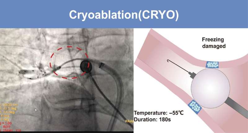 Catheter Ablation Technologies. (A) Fluoroscopic image depicting the cryoballoon catheter positioned at the pulmonary vein ostium. (B) Illustration depicting the principal design of the cryoballoon. Credit: Cardiovascular Innovations and Applications (2024). DOI: 10.15212/CVIA.2023.0079