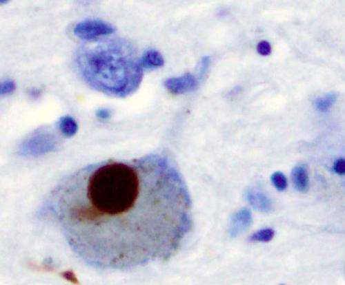 Immunohistochemistry for alpha-synuclein showing positive staining (brown) of an intraneural Lewy-body in the Substantia nigra in Parkinson's disease. Credit: Wikipedia