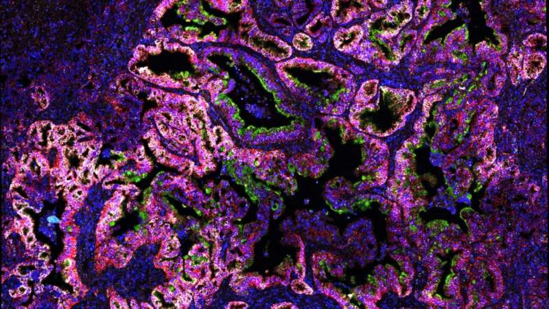 A cross-section of a mouse's early-stage pancreatic tumor. CSHL scientists discovered that early pancreatic cancer cells depend on the regulators of mucus production to survive and grow. Green, purple, yellow, cyan, and white denote areas where mucus production is high. Credit: Tuveson lab/Cold Spring Harbor Laboratory