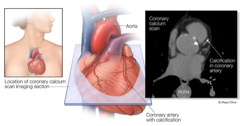 The image on the left shows where the heart is typically located in the body (A). The middle image shows the area of the coronary calcium scan image (B). The image on the right shows a coronary calcium scan (C). Credit: Mayo Clinic News Network