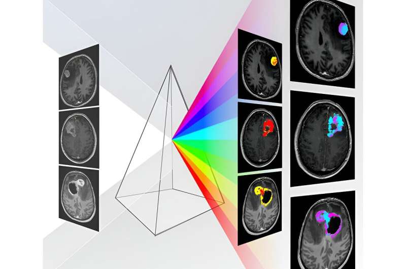 New AI-based, non-invasive diagnostic tool enables accurate brain tumor diagnosis, surpassing current methods 