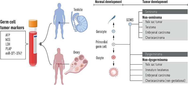 Study reveals lower survival rates for women than men with germ cell tumors