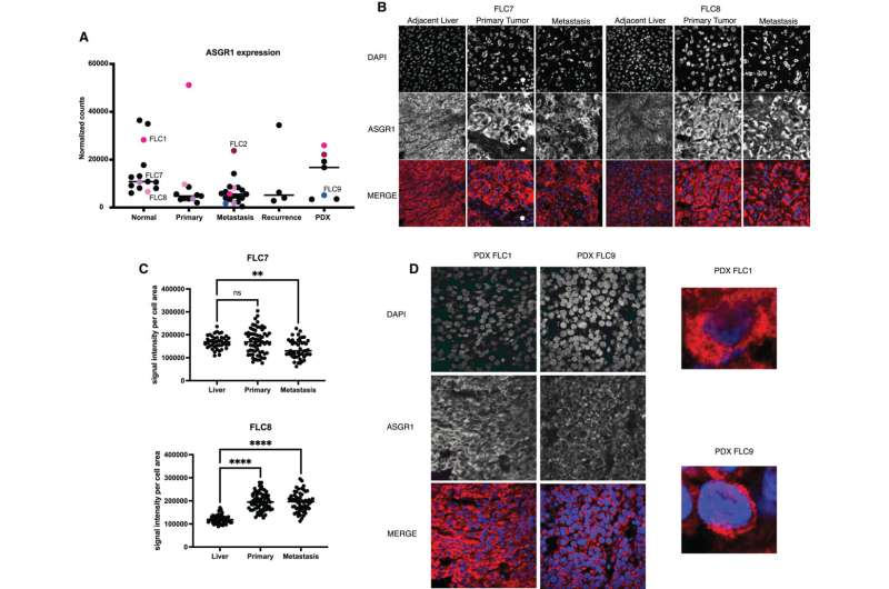 Mechanism for silencing gene expression targets the culprit behind a deadly liver cancer