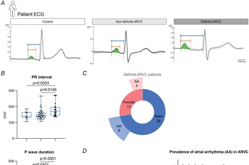A, lead II ECG recordings from an unaffected individual (control) and a non-definite and definite ARVC patient. Individual cardiac cycles over a duration of 10 s (gray traces) are overlaid by detected R waves and averaged (black trace). The PR interval (blue), P wave duration (orange) and P wave area (green) are marked. B, PR interval (box plots with medians indicated) and P wave characteristics (means ± SD indicated) obtained from semi-automated analysis of the averaged ECG. Heart rate (mean ± SEM): control, 73 ± 3 beats/min; non-definite ARVC, 75 ± 2 beats/min; definite ARVC. 60 ± 3 beats/min. P-values from post hoc tests are reported on the graphs [Kruskal–Wallis (P < 0.05) with Dunn's post hoc test for PR interval; one-way ANOVA (P < 0.05) with Bonferroni post hoc test for P wave duration and area]. n (number of patients): control, 12; non-definite ARVC, 42; definite ARVC, 25. C, sex distribution and prevalence of AA in definite ARVC patients in the analyzed registry. D, prevalence of AA in definite ARVC patients in other registries (with weighted mean indicated) and in definite and non-definite ARVC patients in the registry analyzed here. #Please refer to Table 3 for detailed references. Abbreviations: AA, atrial arrhythmia; ARVC, arrhythmogenic right ventricular cardiomyopathy. Credit: The Journal of Physiology (2024). DOI: 10.1113/JP284597