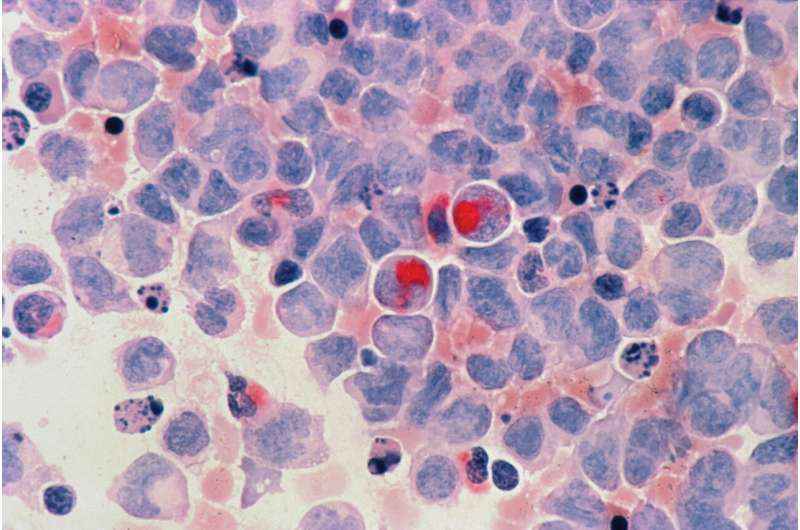 Acute myelocytic leukemia (AML). Credit: Unsplash/CC0 Public Domain