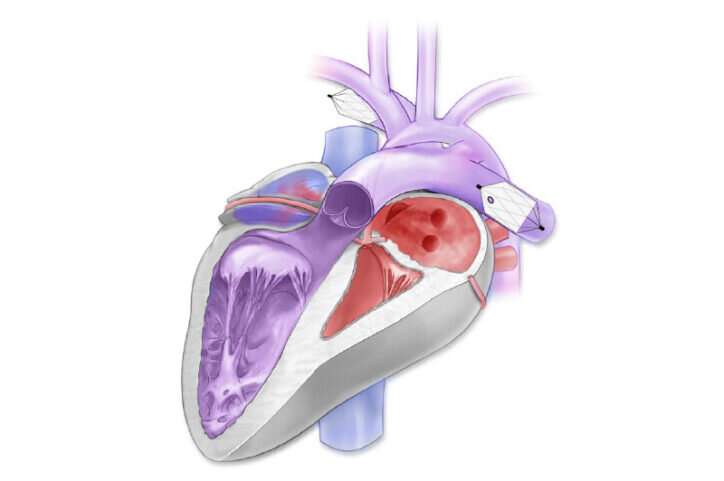 Finding a way to help newborns who can't immediately have heart treatment