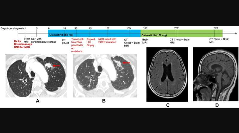 Treatment timeline with chest computed tomography (CT) and brain magnetic resonance images (MRI) on osimertinib. (A) Pretreatment CT chest, demonstrating 18 mm spiculated mass in the left upper lobe (LUL). (B) CT chest following 12 days of Osimertinib treatment, showing decreased size of LUL mass. (C) Pretreatment brain MRI showing no acute abnormalities (axial). (D) Pretreatment brain MRI showing no acute abnormalities (sagittal). Credit: Oncotarget (2024). DOI: 10.18632/oncotarget.28550