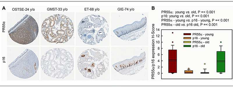 Study: PR55α-controlled PP2A inhibits p16 expression and blocks cellular senescence induction