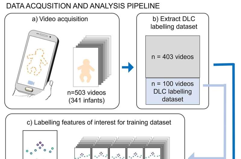 AI technology helps identify cerebral palsy in babies