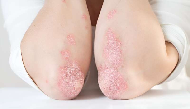 Trials shows bimekizumab response durable at four years for moderate-to-severe psoriasis