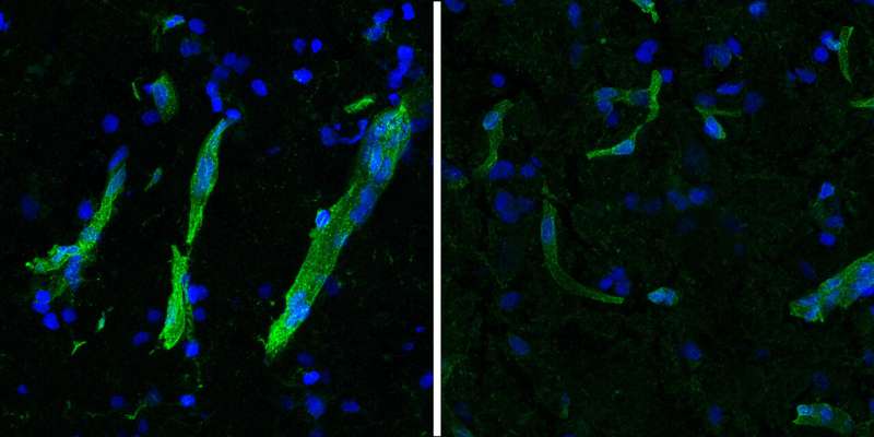 Movement disorder ALS and cognitive disorder FTLD show strong molecular overlaps, new study shows