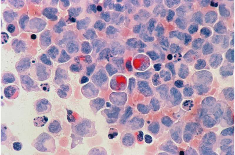 New research identifies promising drug combination for multiple myeloma treatment