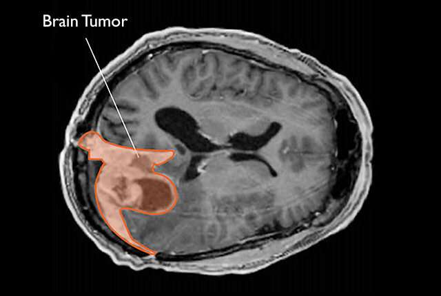 meningiomas