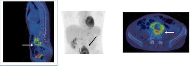 Half body FDG PET aorto – bi – iliac graft with uptake in the left periureteric region. Credit: Clinical Infection in Practice (2023). DOI: 10.1016/j.clinpr.2023.100332