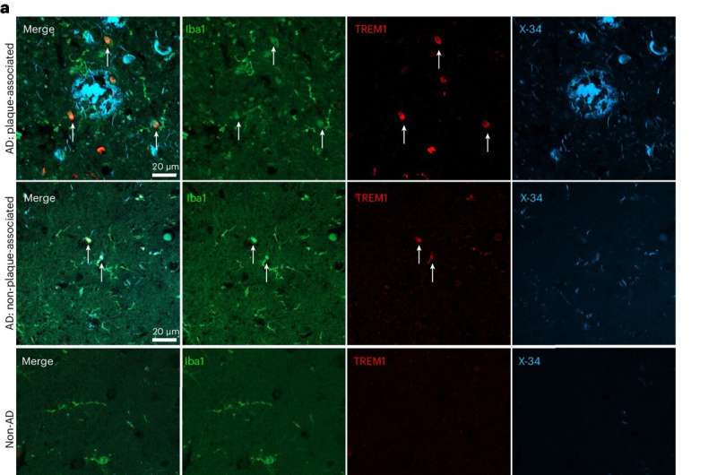 Research links age-related inflammation, microglia and Alzheimer's disease