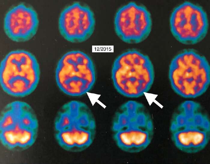 HBOT showed improvement in Alzheimer's disease 