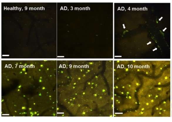 MAO is a possible Alzheimer's disease biomarker 