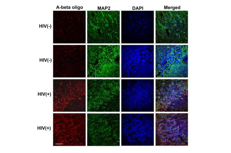 Overlapping mechanisms in HIV cognitive disorders and Alzheimer's disease 