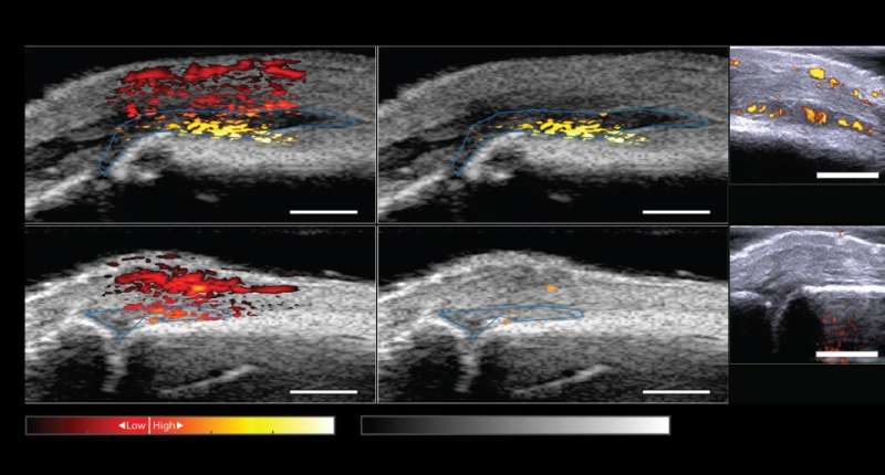 Prototype equipment can detect rheumatoid arthritis