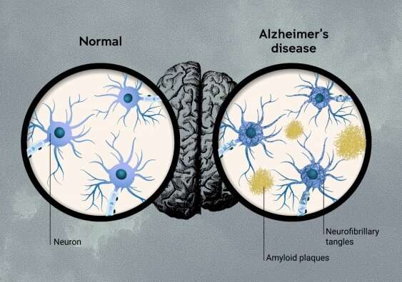 Clinical trial results for lecanemab are a significant step for Alzheimer's, but not a historic breakthrough 