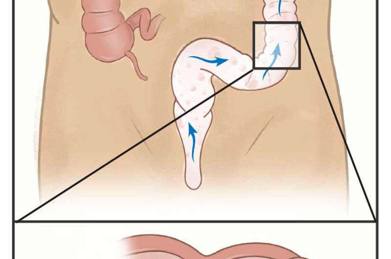 Could carbon monoxide foam help fight inflammation?