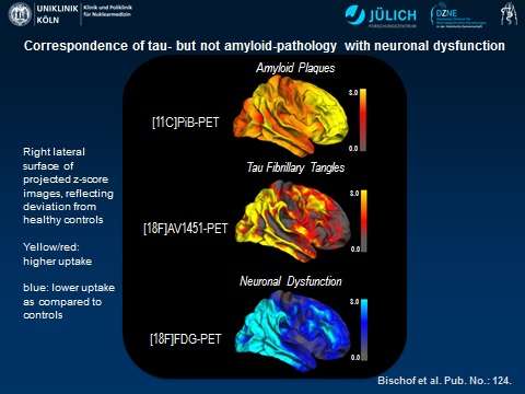 PET points to tau protein as leading culprit in Alzheimer's 