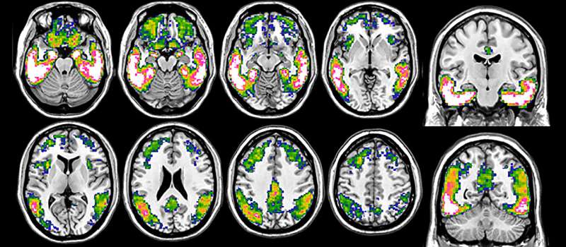 Tau PET: A window into the future of Alzheimer's patients 