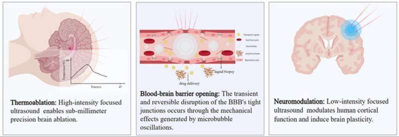 Magnetic resonance-guided focused ultrasound in intracranial diseases