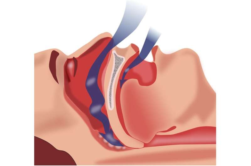 Nerve stimulation for sleep apnea found to be less effective for people with higher BMIs
