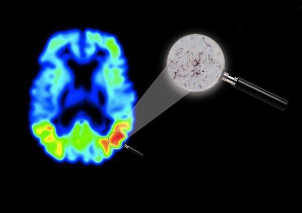 New imaging technique in Alzheimer's disease opens up possibilities for drug development 