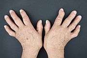 Weekly leflunomide effective for early rheumatoid arthritis