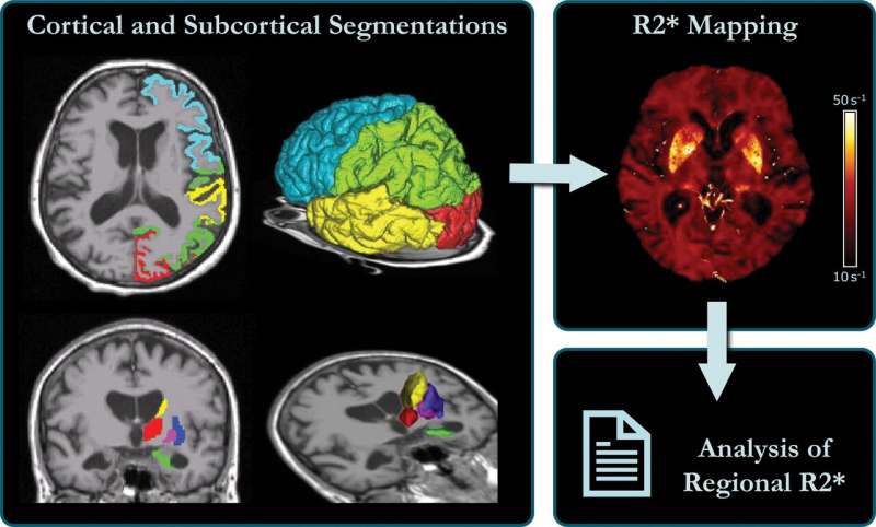 Brain iron accumulation linked to cognitive decline in Alzheimer's patients