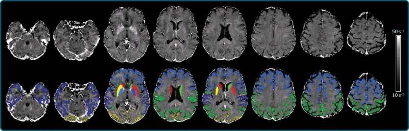 Brain iron accumulation linked to cognitive decline in Alzheimer's patients