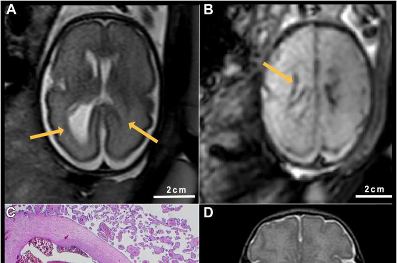 COVID-19 in pregnant women can damage the placenta and the fetus