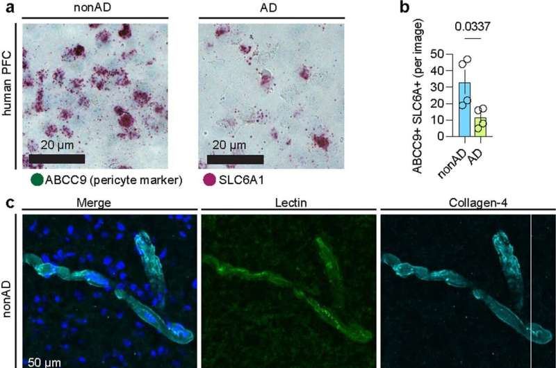 Single-cell dissection of Alzheimer's vascular changes across six brain regions 