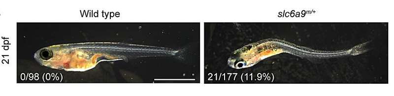 HKUMed researchers uncover key genetic clue in adolescent idiopathic scoliosis